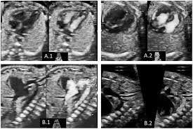 Prenatal Diagnosis Of Down Syndrome Intechopen