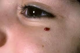 Image result for Pyogenic Granuloma