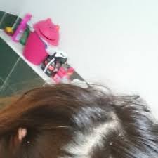 You will see in the section on side effects that some can harm your bones. I Lost More Than Half Of My Hair Due To Depakote Will It Grow Back What Can I Do To Grow It Back Photo