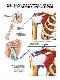 Shoulder pain is a common occurrence for athletes the shoulder is a closely fitted joint. Rotator Cuff Tear Settlements Car Accidents Motorcycle Accidents Etc