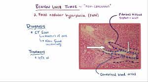 As a rule, they are asymptomatic, but in some cases they cause hepatomegaly, discomfort in the right upper quadrant or abdominal hemorrhage. Benign Liver Tumors Hepatic And Biliary Disorders Merck Manuals Professional Edition