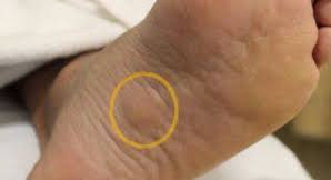If the mass increases in size or pain, the patient should be further evaluated. Plantar Fibroma Perform Podiatry
