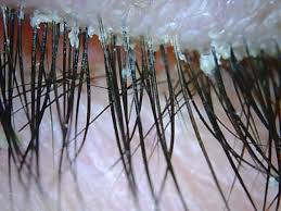 Image result for Demodex folliculorum