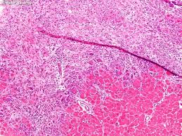 Image result for Myocarditis