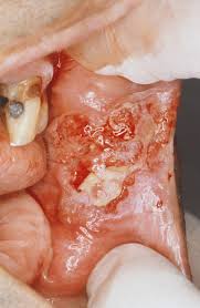 Treatment for throat cancer, no matter at what stage the disease was detected, should be complex and should be started immediately. Oral Squamous Cell Carcinoma Ear Nose And Throat Disorders Msd Manual Professional Edition