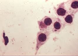 Image result for Chlamydia Trachomatis