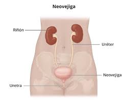 Derivación urinaria - NIDDK