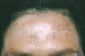 Ultraviolet rays are classified by three types: Index Of Sbtemplates Sbcommon Images Blog Aad Skin Cancer