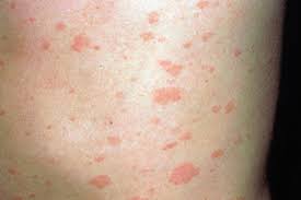 Hiv can contribute to a wide range of std symptoms, including rashes and dry skin in various forms. Pictorial Case Study Itchy Rash With A Large Lesion Gponline
