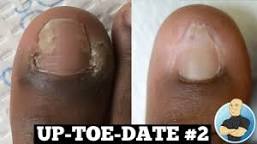 Image of Toenail removal healing stages pictures