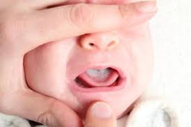 Mengatasi keputihan pada mulut bayi. Lidah Putih Pada Bayi Akibat Susu Atau Infeksi Jamur Ini Bedanya Medisweb