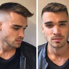 Most guys notice their hairline receding as early as their 20's, 30's, or 40's. Thinning Hair Buzz Cut Receding Hairline Novocom Top