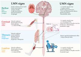 Image result for Neurologic Lesion Localization