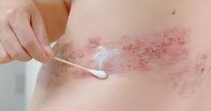 Image result for Skin Infection