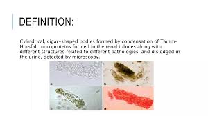 Image result for Urinary Cast