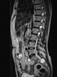 The cancer is approx 4.5cm and it has also spread a bit behind. Syringomyelia Causes Symptoms And Diagnosis