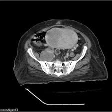 Endometrial Carcinoma Radiology Reference Article Radiopaedia Org