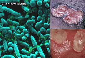 Chancroid Picture Image On Medicinenet Com
