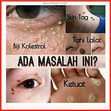 Tahi lalat adalah bintik kecil berwarna cokelat atau kehitaman di atas permukaan kulit. Buy Krim Buang Tahi Lalat Ketuat Kutil Kolestrol Original Seetracker Malaysia