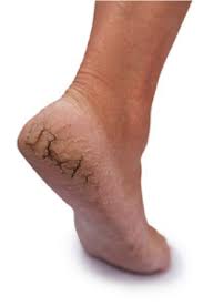 Cracked Heels