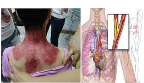 Angin duduk (angina pectoris)terjadi ketika pembuluh darah jantung (koroner) mengalami penyempitan. Kisah Nyata Bukan Sulap Bukan Sihir Inilah Tanda Tanda Masuk Angin Pembawa Maut Angin Duduk Dan Cara Mengatasinya Sebelum Terlambat Pintu Sorga