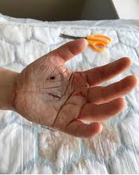 The size of the suture used; The 4 Stages Of Simple Wound Care In Hand Therapy Hand Therapy Academy