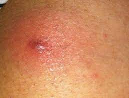 Was Ist Das Fur Ein Pickel Am Po Haut