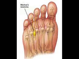 Place a longitudinal line over the dorsal aspect of the interspace between the respective metatarsal. Morton Neuroma Interdigital Neuralgia Youtube