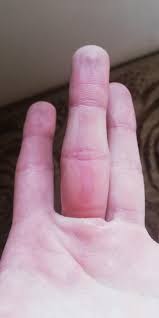 What is the best pain medication for burns? I Held N2o Cracker Wrong And It Gave Me Ice Burn Should I Be Worrying How To Treat This Nitrousoxide