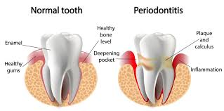 Our Services Cresta Dental Implants