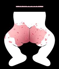 Windeldermatitis Was Hilft Bei Wundem Baby Po Kanyo