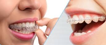If you have invisalign aligners, you need to be really careful not to lose them. How Do You Know You Need Braces