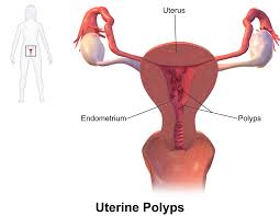 Endometriosis is a painful condition in which endometrial tissue grows outside the uterus, often in the pelvic area. Ø³Ù„ÙŠÙ„Ø© Ø¨Ø·Ø§Ù†Ø© Ø§Ù„Ø±Ø­Ù… ÙˆÙŠÙƒÙŠØ¨ÙŠØ¯ÙŠØ§