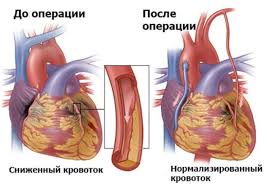 Aortokoronarnoe Shuntirovanie Aksh Na Rabotayushem Serdce V Moskve Cena Pokazaniya K Provedeniyu
