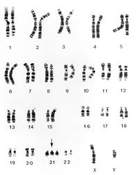 Down syndrome is a genetic disorder. Down Syndrome Trisomy 21 Pediatrics Msd Manual Professional Edition