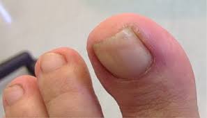 Image result for Toenail Removal