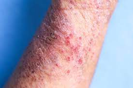 27 Skin Soothing Tips And Products People With Eczema Swear By
