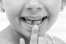 Tooth Extractions In Children Nova Pediatric Dentistry Orthodontics