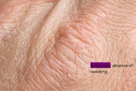 Image result for Anhidrosis