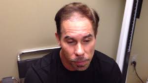 We offer free consultations to those concerned about losing their hair, wanting to learn more about hair loss and those interested in finding a hair restoration solution. Jose S Bosley Hair Transplant Review 2 Weeks Post Procedure Youtube