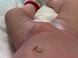 Image result for Inguinal hernia child