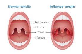 Should I Have My Tonsils Removed Dr Gan Eng Cern