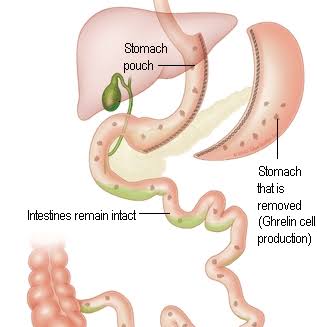 Sleeve Gastrectomy product image