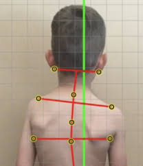 See full list on mayoclinic.org And This Is Why We Check Kids The Spinal Centre