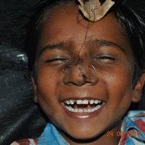 PDF) Tripod suspension and stabilisation: an innovative splintage technique  for closed reduction of comminuted and compound fractures of the nasal bones