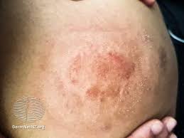 Image result for itchy skin rectum