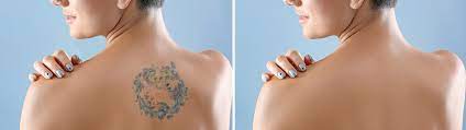 The timeline of this treatment varies greatly from person to person, but most patients need between six and twelve sessions to completely remove a tattoo. How Long Does It Take For A Tattoo To Fade Bella Tu Med Spa