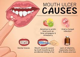 Image result for mouth ulcer on tongue)
