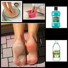 Calo Na Sola Do Pé O Que Fazer Pes Macios Com Listerine E Vinagre Veja A Receita Listerine Para Os Pes Pele Morta Tratamento Para Os Pes