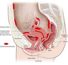 Dans l'endométriose, des fragments de tissu endométrial de taille variable, qui normalement ne sont présents que dans la muqueuse utérine (endomètre), sont . Endometriose Gesundheitsinformation De